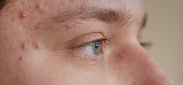 Man with Acne on his face